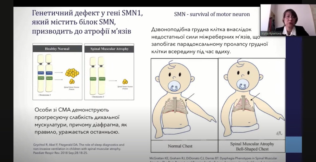 Респіраторна підтримка у педіатричних пацієнтів із СМА